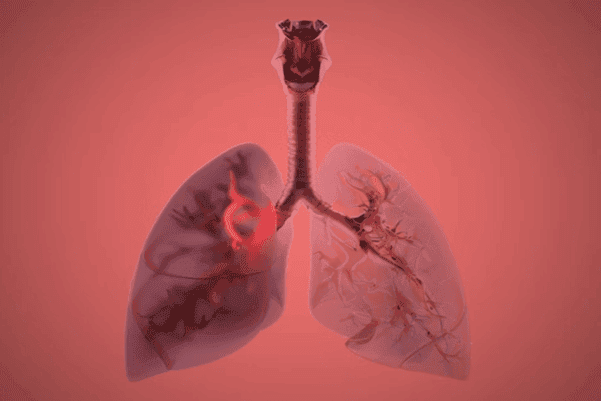 Air Pollution Now Linked to Smoking-Like DNA Damage and Rising Lung Cancer in Non-Smokers