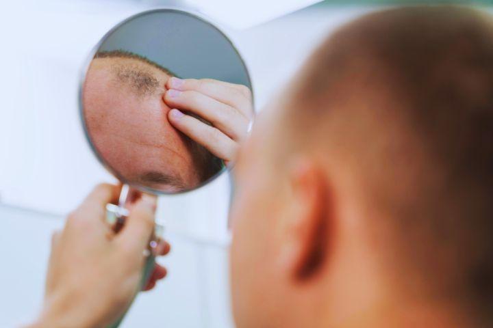 minoxidil-shortage-concern-for-hair-loss