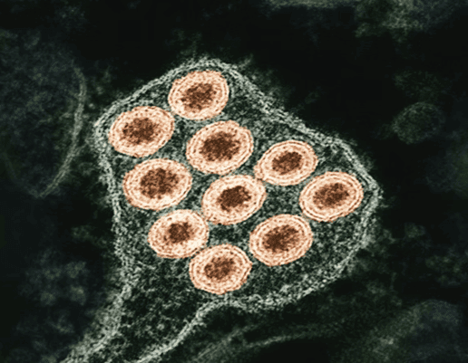 Measles Returns to South Carolina: A Call for Public Health Action